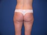 Liposuction