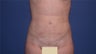Liposuction
