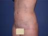 Liposuction