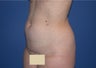 Liposuction