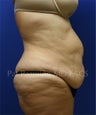Tummy Tuck