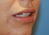 Lip Augmentation