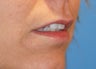 Lip Augmentation