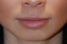 Lip Augmentation
