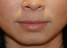 Lip Augmentation