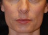 Mole removal 