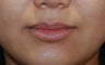 Lip Augmentation