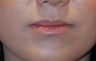 Lip Augmentation