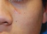 Mole removal 