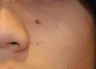 Mole removal 