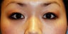 Asian bleph