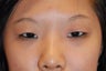 Asian bleph