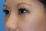 Asian blepharoplasty