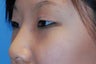 Asian blepharoplasty