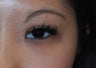 Asian blepharoplasty
