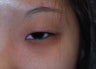 Asian blepharoplasty