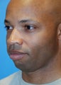 Chin implant 