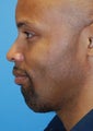 Chin Implant