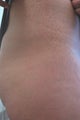 Laser for Stretch Marks