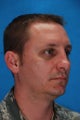 Rhinoplasty
