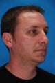 Rhinoplasty