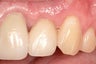 Single Implant