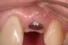 Single Implant