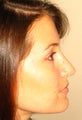 Rhinoplasty