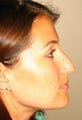 Rhinoplasty