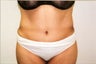 Tummy Tuck