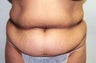 Tummy Tuck