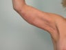 Arm Lift / Brachioplasty