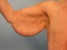Arm Lift / Brachioplasty