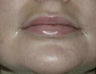 Permasil lip augmentation