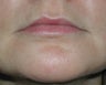 Permasil lip augmentation
