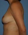 Breast Lift