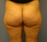 Liposuction