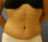 Tummy Tuck