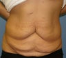 Tummy Tuck