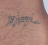 Chest Tattoo Removal - Lasers 