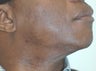 Laser Hair Removal