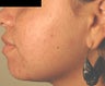 Lumenis Lightsheer Permanent Facial Laser Hair Removal 