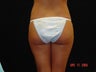 Buttocks Augmentation 