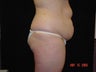 Tummy Tuck