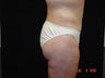 Body Lift with Liposuction of Abdomen, Waist, and Flanks