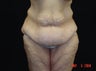 Body Lift