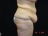 Body Lift, Outer Thigh Lift, Buttocks Lift