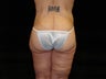 Body Lift, Outer Thigh Lift, Buttocks Lift