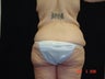 Body Lift, Outer Thigh Lift, Buttocks Lift