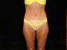 Body Lift with Liposuction of Abdomen, Waist, and Flanks